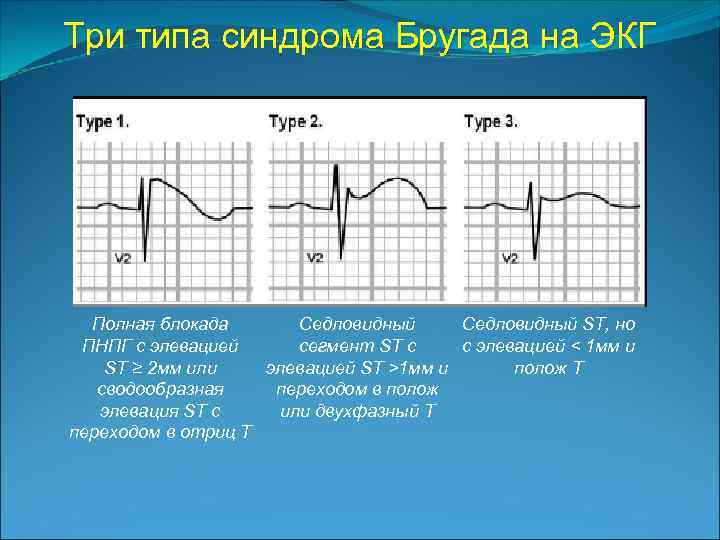 Три типа синдрома Бругада на ЭКГ Полная блокада Седловидный ST, но ПНПГ с элевацией