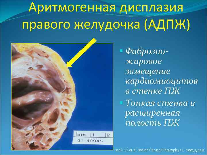 Аритмогенная дисплазия правого желудочка (АДПЖ) Фиброзножировое замещение кардиомиоцитов в стенке ПЖ Тонкая стенка и