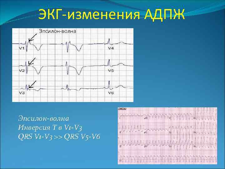 ЭКГ-изменения АДПЖ Эпсилон-волна Инверсия Т в V 1 -V 3 QRS V 1 -V