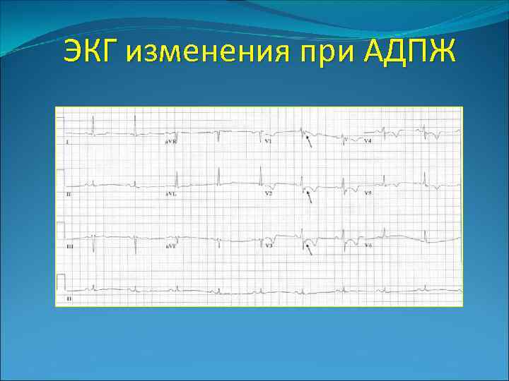 ЭКГ изменения при АДПЖ 