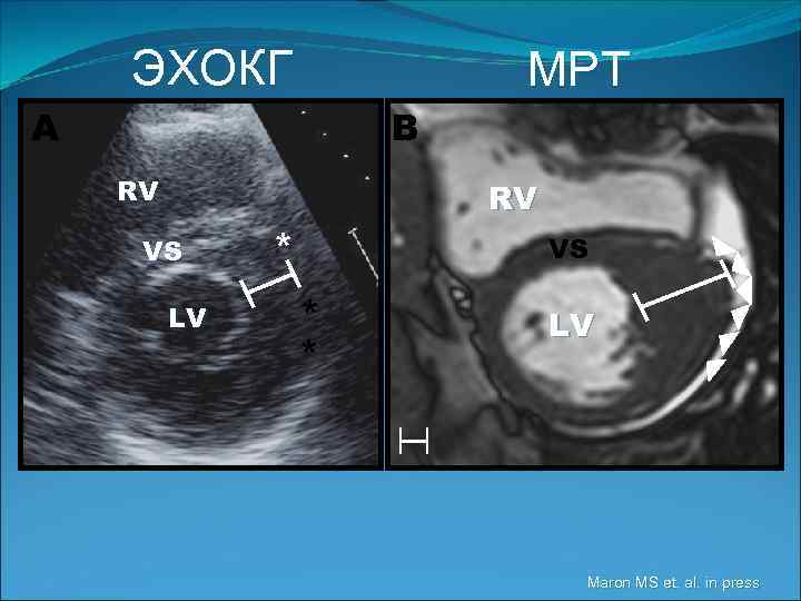 ЭХОКГ МРТ A B RV RV VS LV * VS * * LV Maron