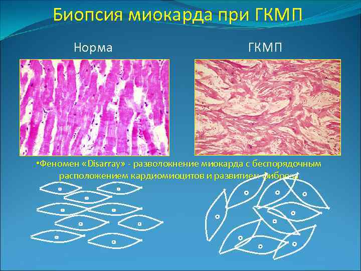 Биопсия миокарда при ГКМП Норма ГКМП • Феномен «Disarray» - разволокнение миокарда с беспорядочным