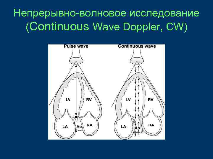 Непрерывно-волновое исследование (Continuous Wave Doppler, CW) 