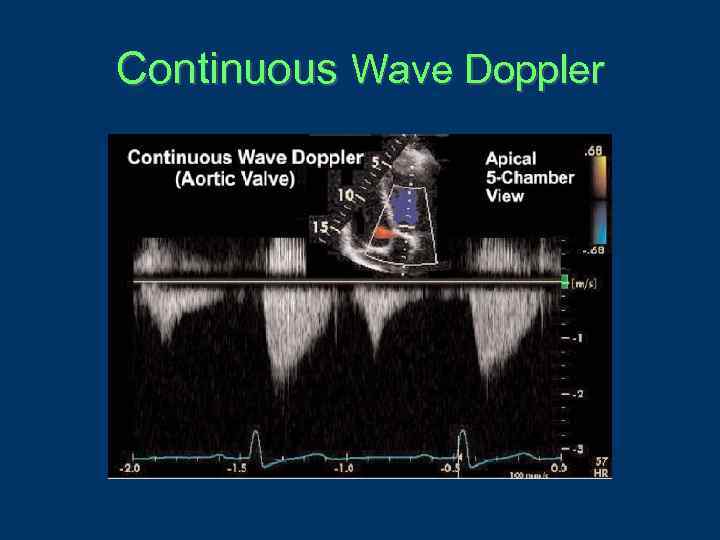 Continuous Wave Doppler 