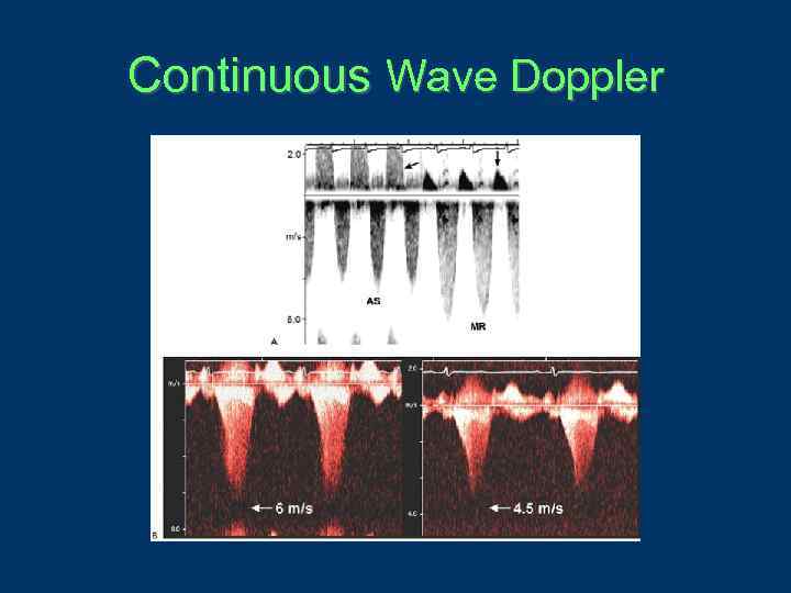 Continuous Wave Doppler 