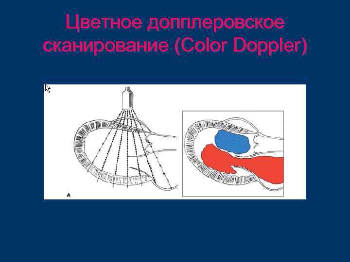 Цветное допплеровское сканирование (Color Doppler) 