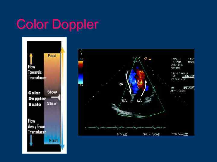 Color Doppler 