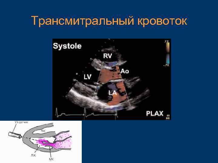 Эхокардиография с допплеровским анализом