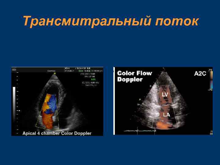 Трансмитральный поток 