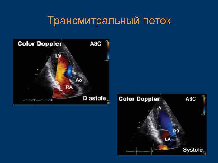 Трансмитральный поток 
