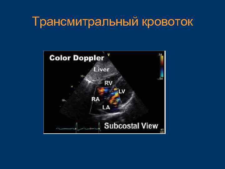 Трансмитральный кровоток 