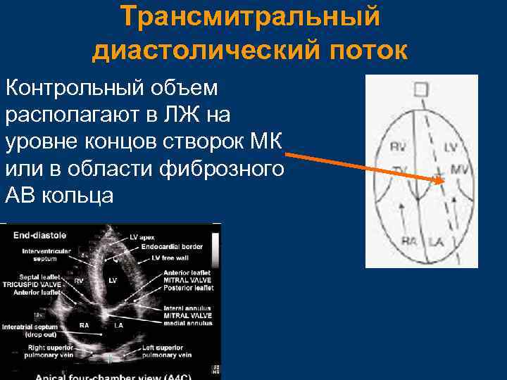 Контрольный объем. Трансмитральный поток. Диастолический поток. Показатели трансмитрального диастолического потока. Трансмитральный поток норма.