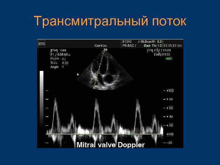 Трансмитральный поток 