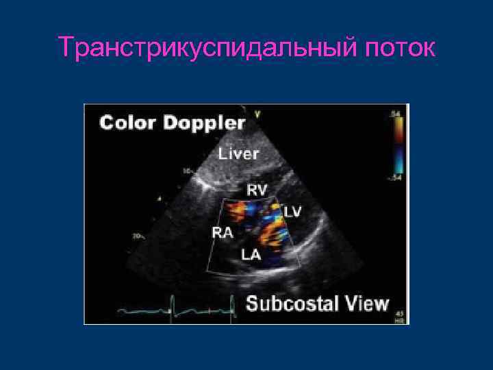 Транстрикуспидальный поток 