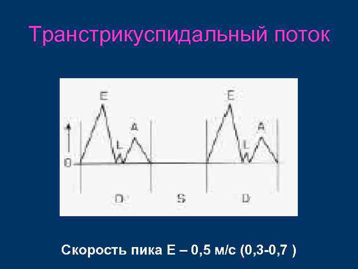 Транстрикуспидальный поток Скорость пика Е – 0, 5 м/с (0, 3 -0, 7 )