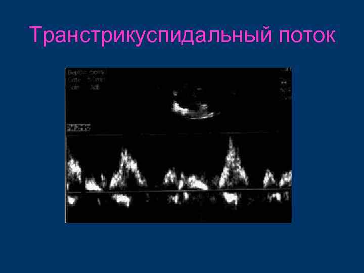 Транстрикуспидальный поток 