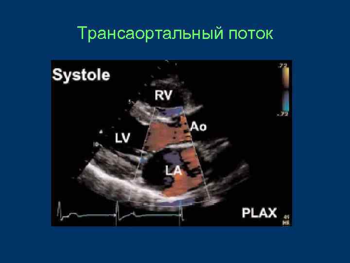 Трансаортальный поток 