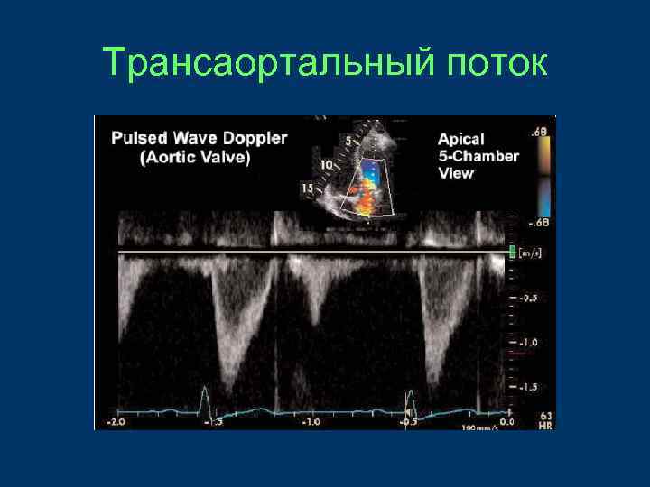 Трансаортальный поток 