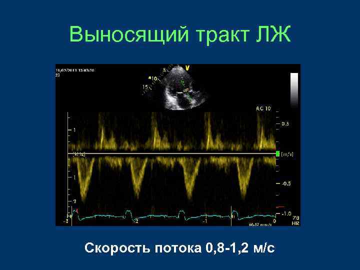 Выносящий тракт ЛЖ Скорость потока 0, 8 -1, 2 м/с 