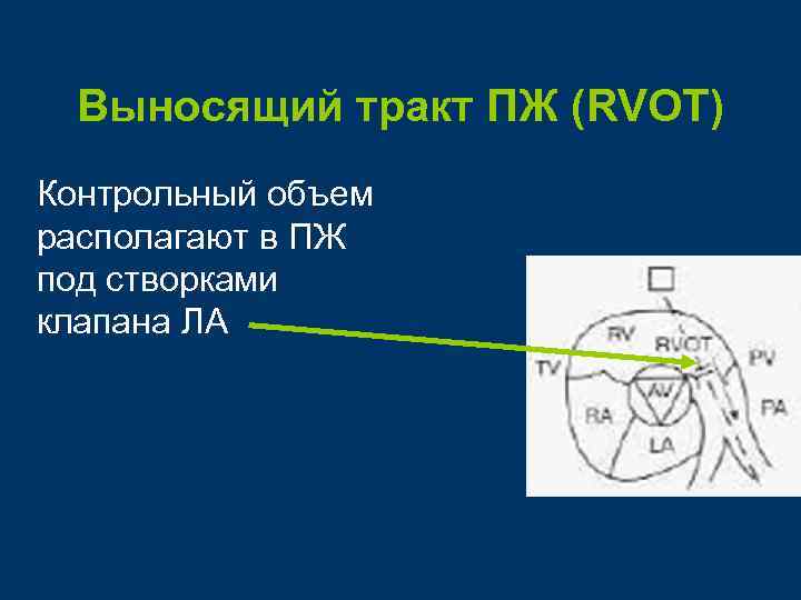 Выносящий тракт ПЖ (RVOT) Контрольный объем располагают в ПЖ под створками клапана ЛА 