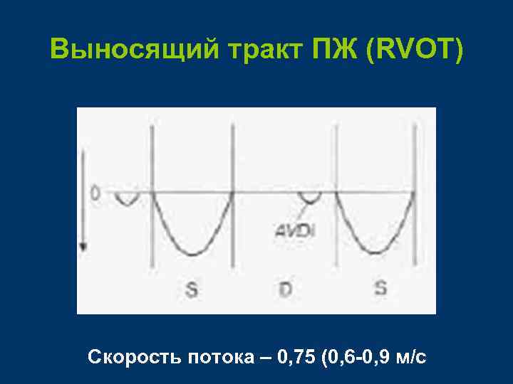 Выносящий тракт ПЖ (RVOT) Скорость потока – 0, 75 (0, 6 -0, 9 м/с