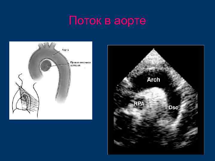 Поток в аорте 