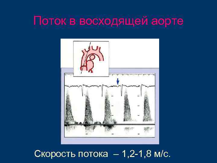 Поток в восходящей аорте Скорость потока – 1, 2 -1, 8 м/с. 