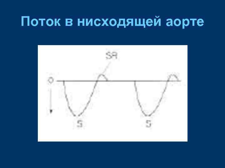 Поток в нисходящей аорте 