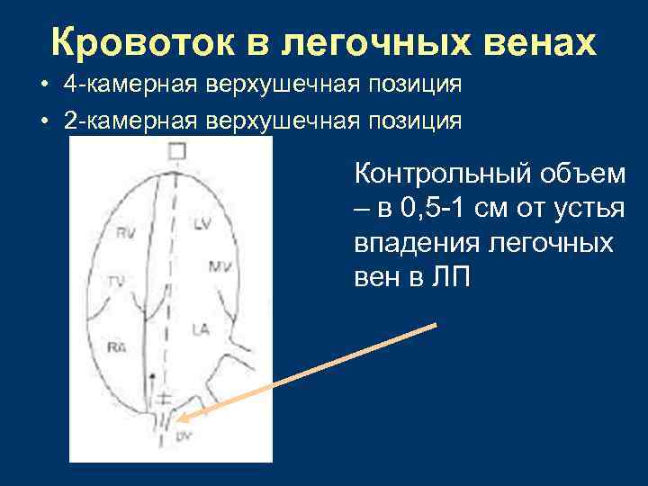 Камерная карта. Кровоток в легочных венах. Оценка кровотока в легочных венах. Поток в лёгочных венах. Двухкамерная верхушечная позиция.