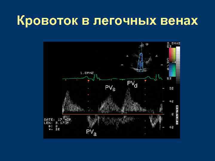 Эхокардиография с допплеровским анализом