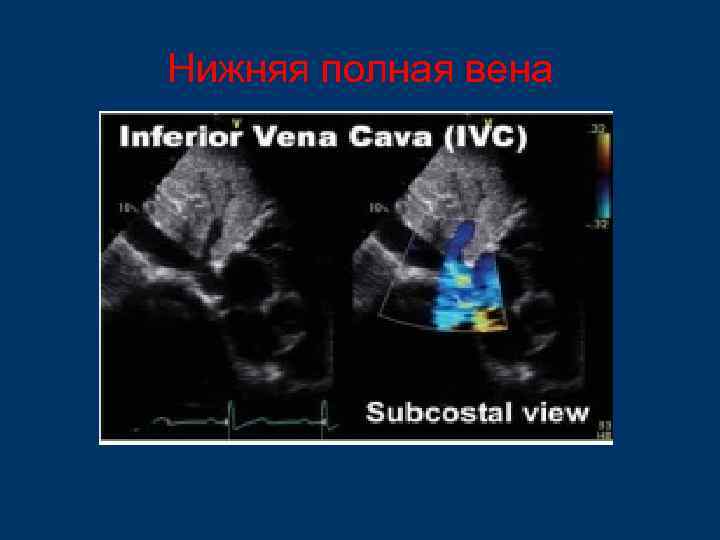 Нижняя полная вена 