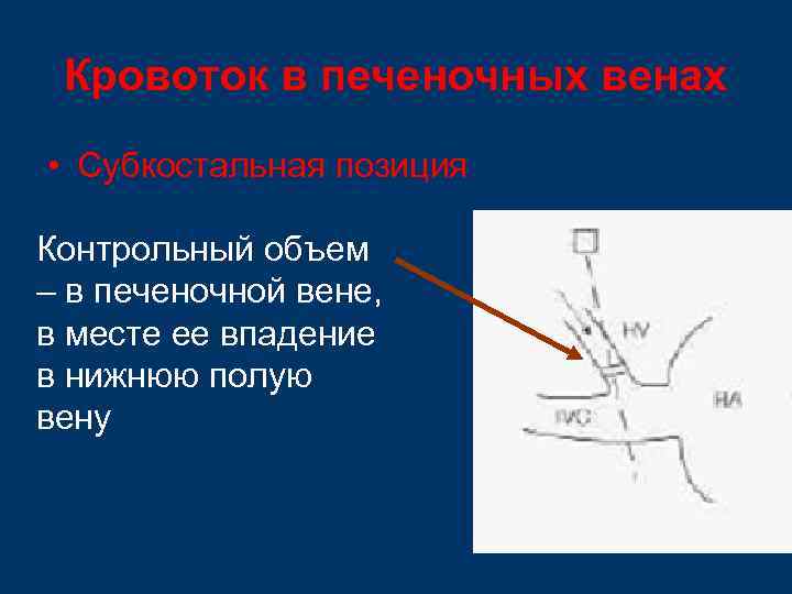 Кровоток в печеночных венах • Субкостальная позиция Контрольный объем – в печеночной вене, в