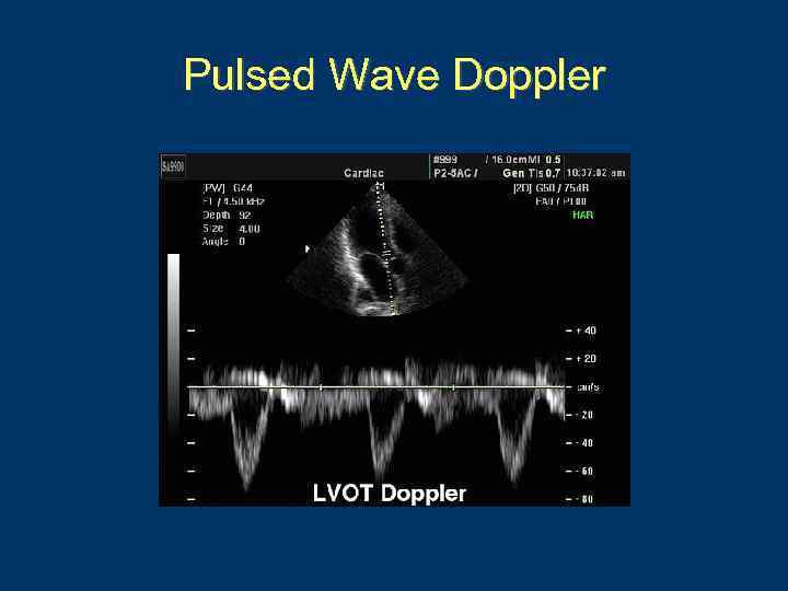 Pulsed Wave Doppler 