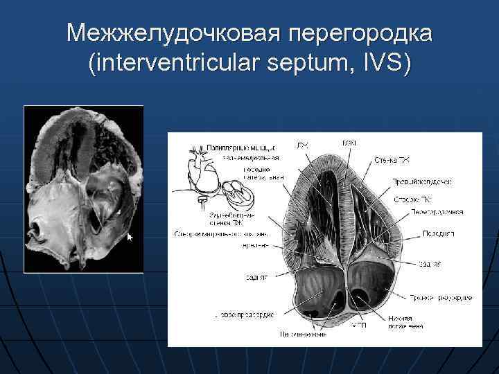 Межжелудочковая перегородка (interventricular septum, IVS) 