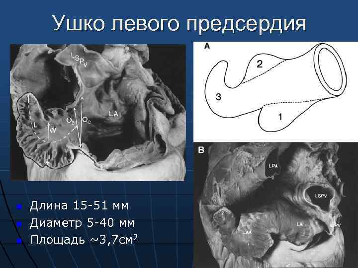 Тромбоз ушка предсердия. Ушко левого предсердия на эхокардиографии.