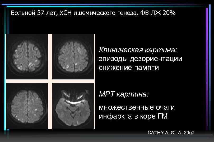 Больной 37 лет, ХСН ишемического генеза, ФВ ЛЖ 20% Клиническая картина: эпизоды дезориентации снижение