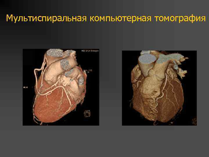 Мультиспиральная компьютерная томография 