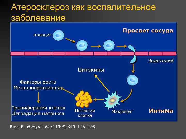 Атеросклероз как воспалительное заболевание Просвет сосуда моноцит Эндотелий Цитокины Факторы роста Металлопротеиназы Пролиферация клеток