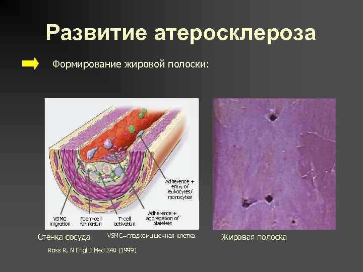 Развитие атеросклероза Формирование жировой полоски: Adherence + entry of leukocytes/ monocytes VSMC migration Foam-cell