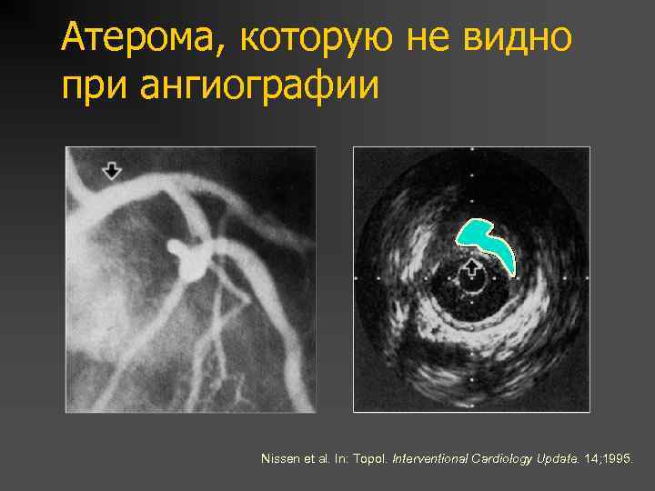 Атерома, которую не видно при ангиографии Nissen et al. In: Topol. Interventional Cardiology Update.