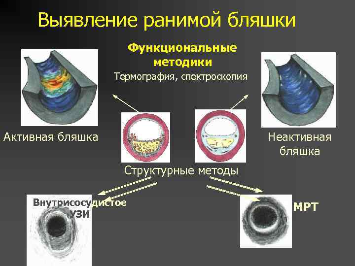 Выявление ранимой бляшки Функциональные методики Термография, спектроскопия Активная бляшка Неактивная бляшка Структурные методы Внутрисосудистое