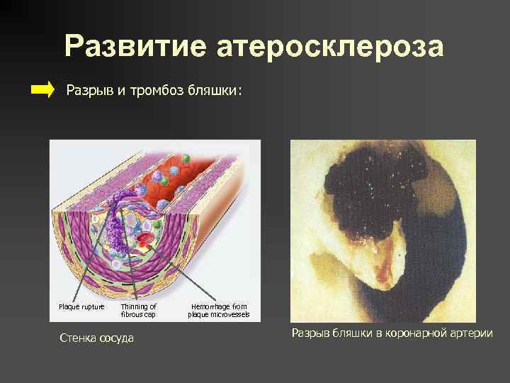 Развитие атеросклероза Разрыв и тромбоз бляшки: Plaque rupture Thinning of fibrous cap Стенка сосуда