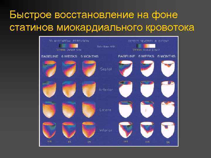 Быстрое восстановление на фоне статинов миокардиального кровотока 