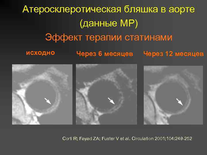 Атеросклеротическая бляшка в аорте (данные МР) Эффект терапии статинами исходно Через 6 месяцев Через