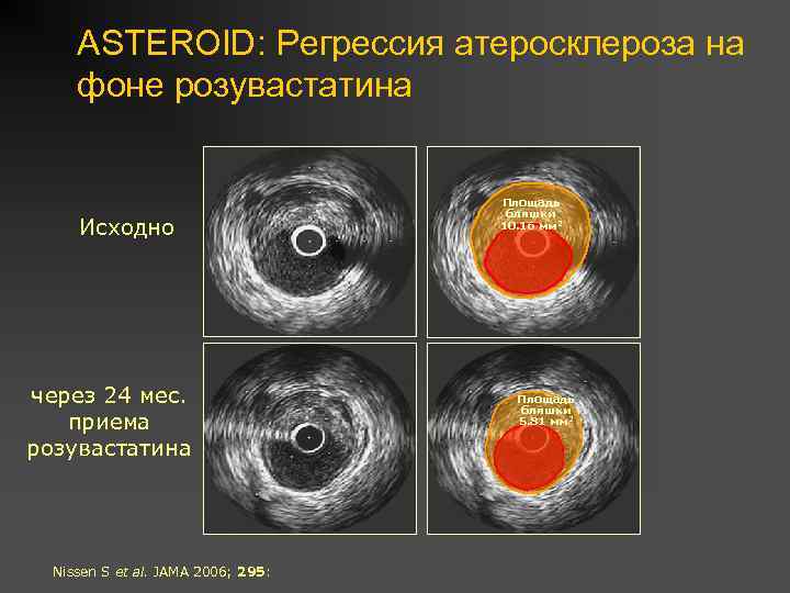 ASTEROID: Регрессия атеросклероза на фоне розувастатина Исходно через 24 мес. приема розувастатина Nissen S