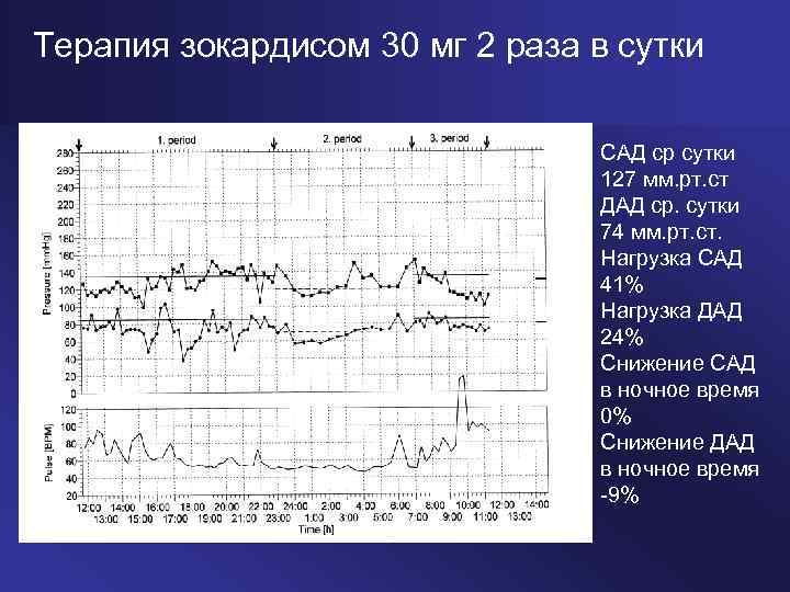 Терапия зокардисом 30 мг 2 раза в сутки САД ср сутки 127 мм. рт.