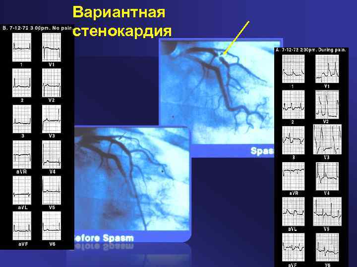 Вариантная стенокардия 