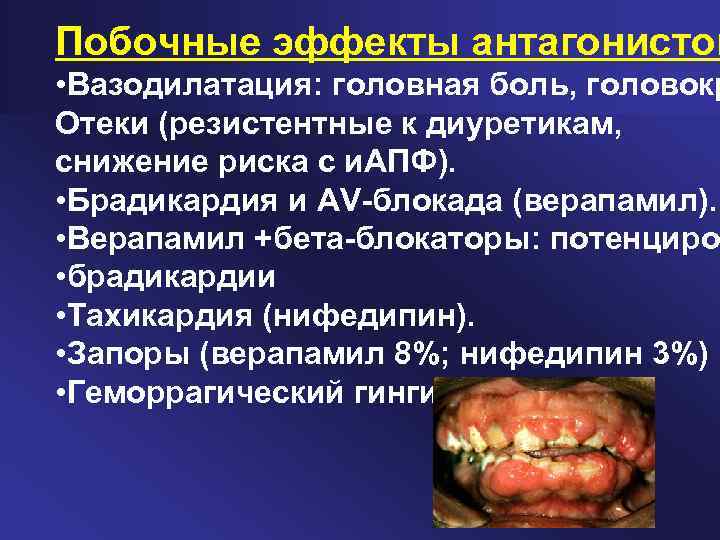 Побочные эффекты антагонистов • Вазодилатация: головная боль, головокр Отеки (резистентные к диуретикам, снижение риска