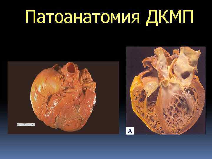 Патоанатомия ДКМП 