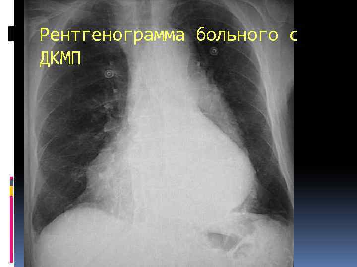 Рентгенограмма больного с ДКМП 